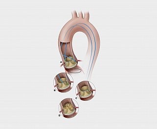  In the BASILICA procedure, doctors use a catheter to position a snare underneath an aortic leaflet. Using another catheter, they direct a guidewire through the base of the aortic leaflet and into the snare (A). The snare is pulled back (B), and the guidewire is electrified to cut the leaflet (C). The leaflet splays after TAVR, permitting blood flow (D). 