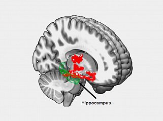 Brain imaging after one night of sleep deprivation revealed beta-amyloid accumulation (red) in the hippocampus and nearby regions. 