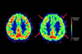 PET scans show the higher brain activity of a 50-year-old woman on a Mediterranean-style diet (left, image shows more red, which indicates higher activity) and a 50-year-old on a Western diet most of her life (right, image shows much less red). Arrows point to areas that are typically affected by Alzheimer’s disease, with lower activity for Western diet.