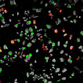 Neural cells infected with Zika virus