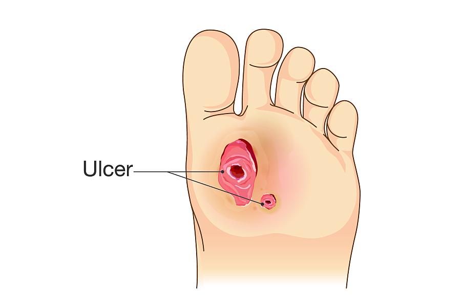 Diabetic Foot Pain and Ulcers. Skin Sores on Foot. Illustration about Diabetes Symptoms. 