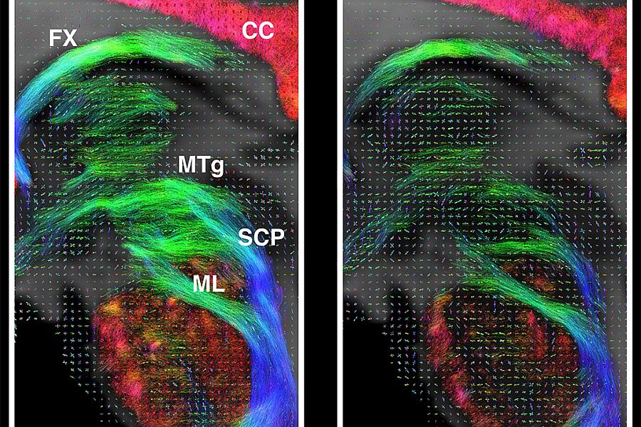 colorful tractography image of the brain showing a before and after using different scanners