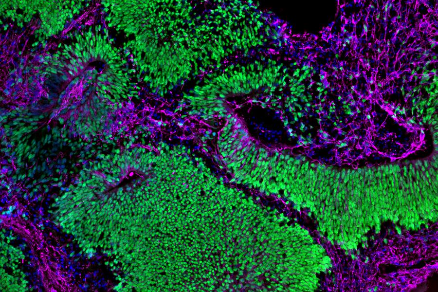 Brain organoid depicting neural stem cells in green and neurons in magenta. Both cell types are abundant, showing normal development.