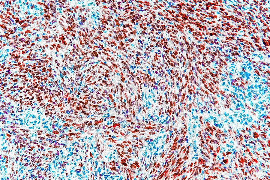 Expression of HHV-8 LANA in Pediatric Kaposi Sarcoma