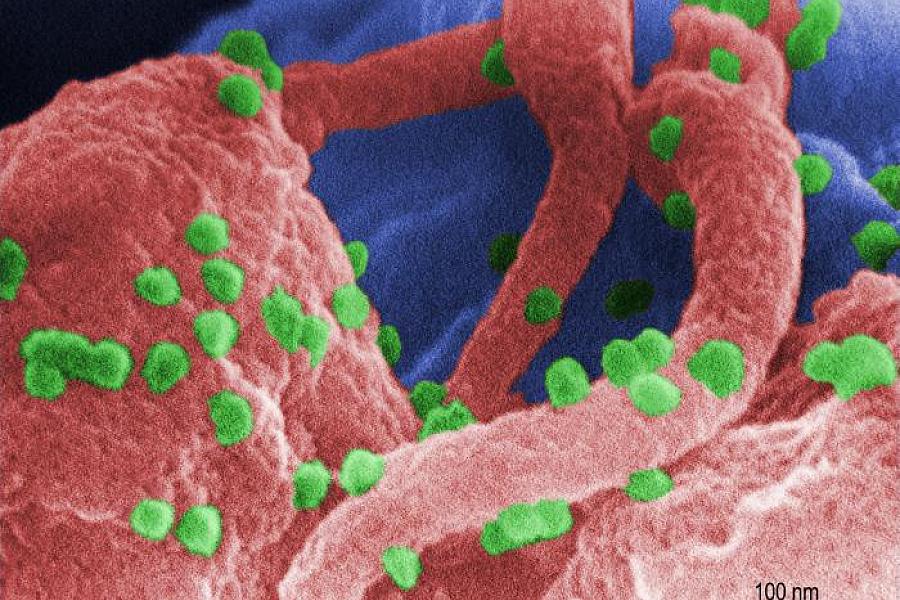 Scanning electron micrograph shows HIV as tiny green spheres scattered atop the surface of a lymphocyte cell.