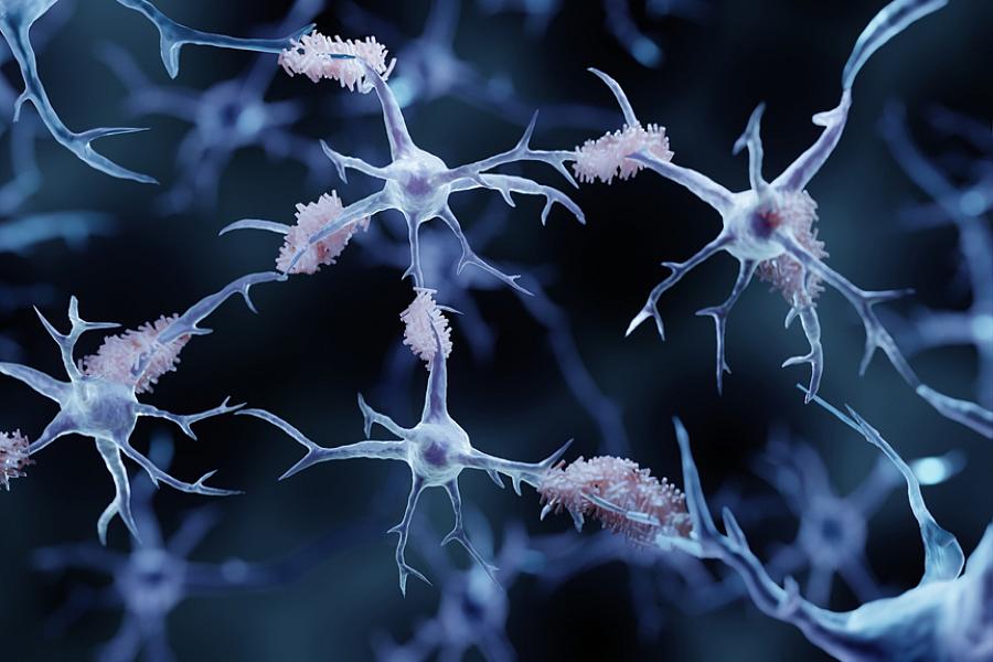 3-D illustration of amyloid plaques and neurons.