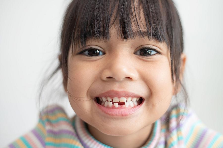 Image of a young girl smiling with missing bottom teeth.