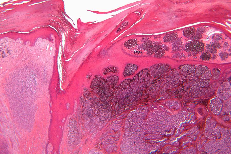 Microscope view of malignant melanoma 