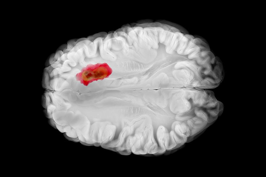 Axial view of the brain showing a glioblastoma in the left frontal lobe with central necrosis, peripheral infiltration, and early midline shift