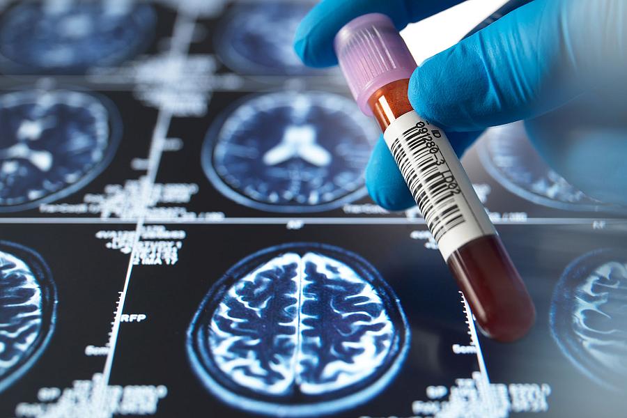 Close-up shot of a medical professional holding a blood sample vial over brain scan images