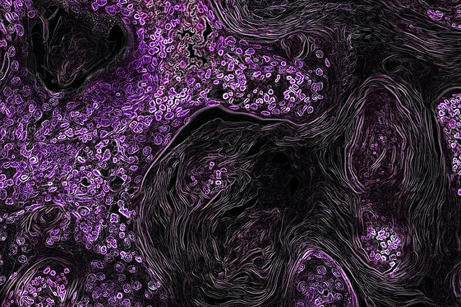 Microscope image of a tumor in a mouse lung. 