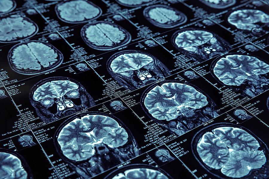 Photo of multiple brain images from MRI scans.
