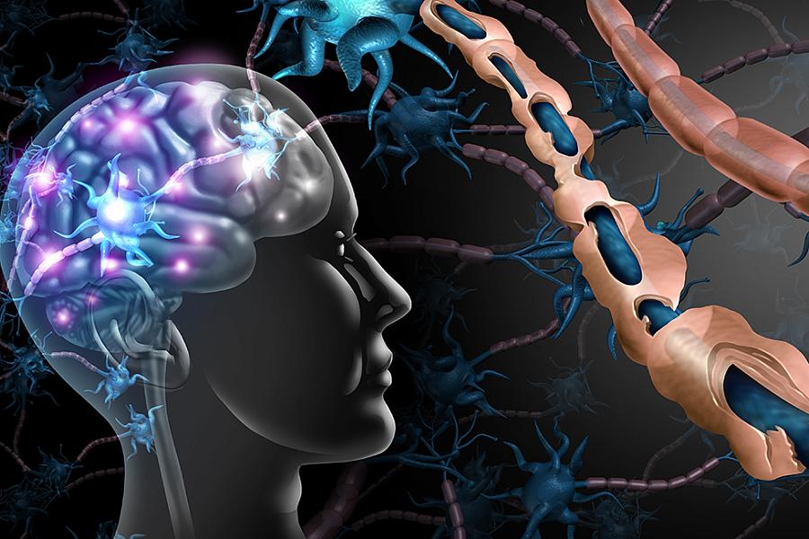 Depiction of deteriorating myelin sheaths in the brain