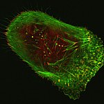 Human malignant melanoma cell viewed through a fluorescent, laser-scanning confocal microscope.