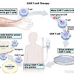 CAR T-Cell Therapy