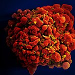 Scanning electron micrograph of an HIV-infected H9 T cell.