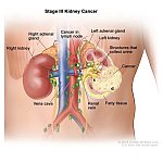 Anatomic illustration of stage 3 kidney cancer