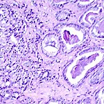 Histological slide of prostate cancer