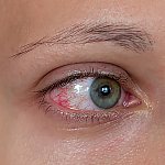 A close-up of an eye with redness