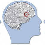 Brains compensating for dyslexia vs. brain of a typical reader