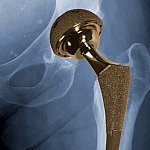 Graphic of hip showing metal-on-metal implant.