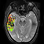 Image of stroke brain