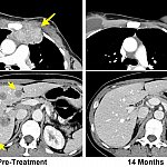 MRI scans from cancer patient