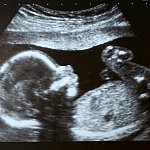 An ultrasound image of a fetus