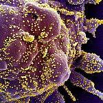Colorized scanning electron micrograph of an apoptotic cell (purple) heavily infected with SARS-COV-2 virus particles (yellow), isolated from a patient sample.