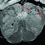 Scan of deceased COVID-19 patient’s brain