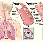 Illustration showing how asthma affects airways
