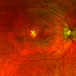 Retinal images of a patient with a TIMP3 mutation causing atypical symptoms. While there is visible damage in the retina (dark circles), there is no CNV present. 