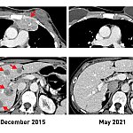 CT scans showing metastatic lesions before and after TIL therapy 