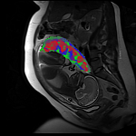 Image of a placental MRI scan
