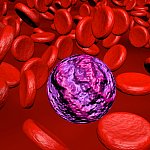 3D rendering of acute myeloid leukemia