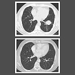 two lung scans showing before and after treatment, top image shows large lesion, bottom image shows disappearance of lesion