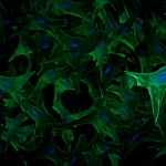 Genomic variation in the STAT4 gene causes disorganized fibroblasts that fail to heal wounds properly. The nuclei of the fibroblasts are shown in blue. 
