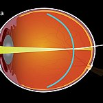 Diagram of an eye with myopia
