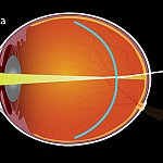 Diagram of an eye with myopia