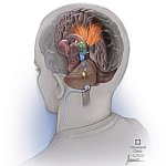 Illustration of a single DBS lead implanted into the cerebellum