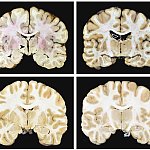Images of human brain cross sections.