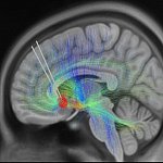 MRI scan of a brain with an implanted DBS device.