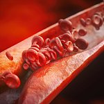 medical illustration of arterial plaque