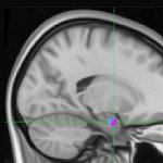 Image of brain region showing the probability of persistent apnea