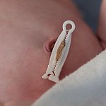 Image of an umbilical cord clamp on a newborn.