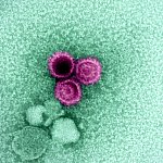 An electron micrograph showing three Epstein-Barr virus (EBV) particles colorized pink