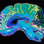colorized image of a brain MRI