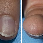 Image of a fingernail with onychopapilloma
