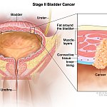Medical illustration of stage 2 bladder cancer