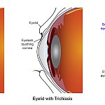 Two common surgeries equally effective for treating blinding condition of the eyelid